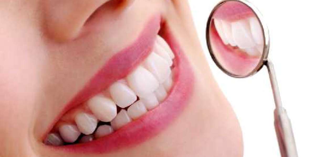 The Benefits of Getting Dental Crowns in Wimbledon for Your Teeth