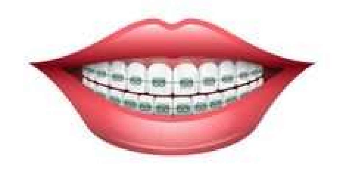 Transform Your Smile with Expert Orthodontics in Bexleyheath